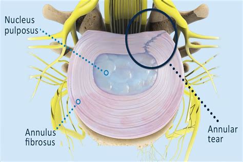 annular ligament tear test|annular ligament injury symptoms.